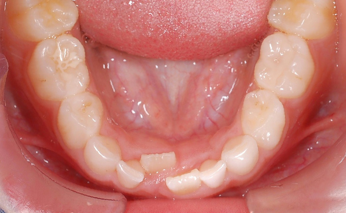 叢生（そうせい）