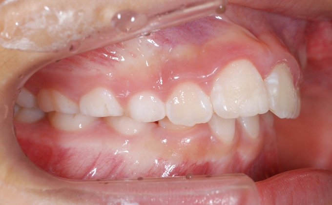 上顎前突（出っ歯）