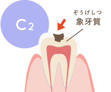 むし歯が象牙質まで進行した状態