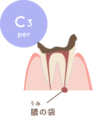 むし歯が歯髄まで進行し痛みを伴う状態
