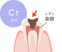 むし歯が歯髄まで進行し痛みを伴う状態
