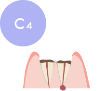 歯そのものが崩壊し、根だけが残っている状態